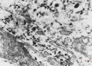 F,58y. | lymph node - metastasis of malignant melanoma F,58y. | lymph node - metastasis of malignant melanoma